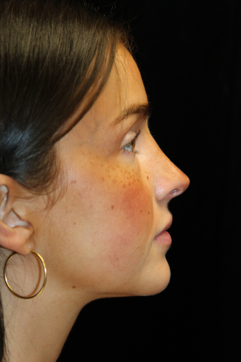 After Image: Closed Preservation Septorhinoplasty - 