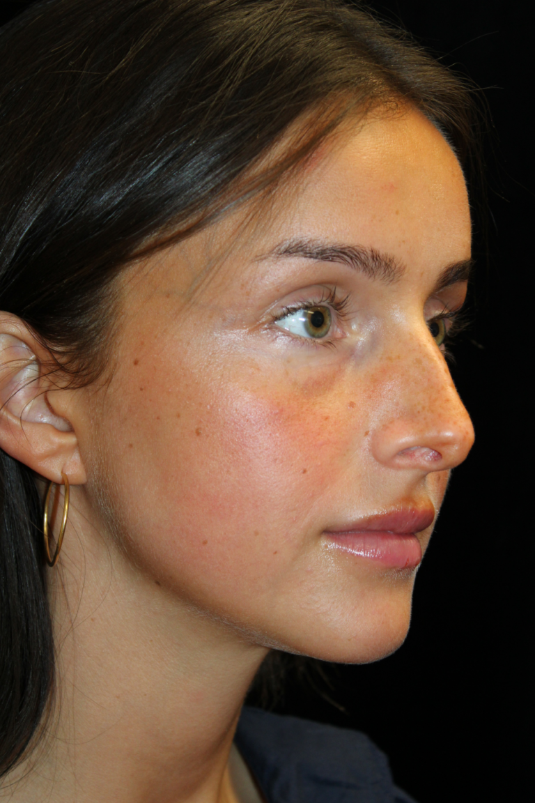 Before Image: Closed Preservation Septorhinoplasty - right-front-oblique