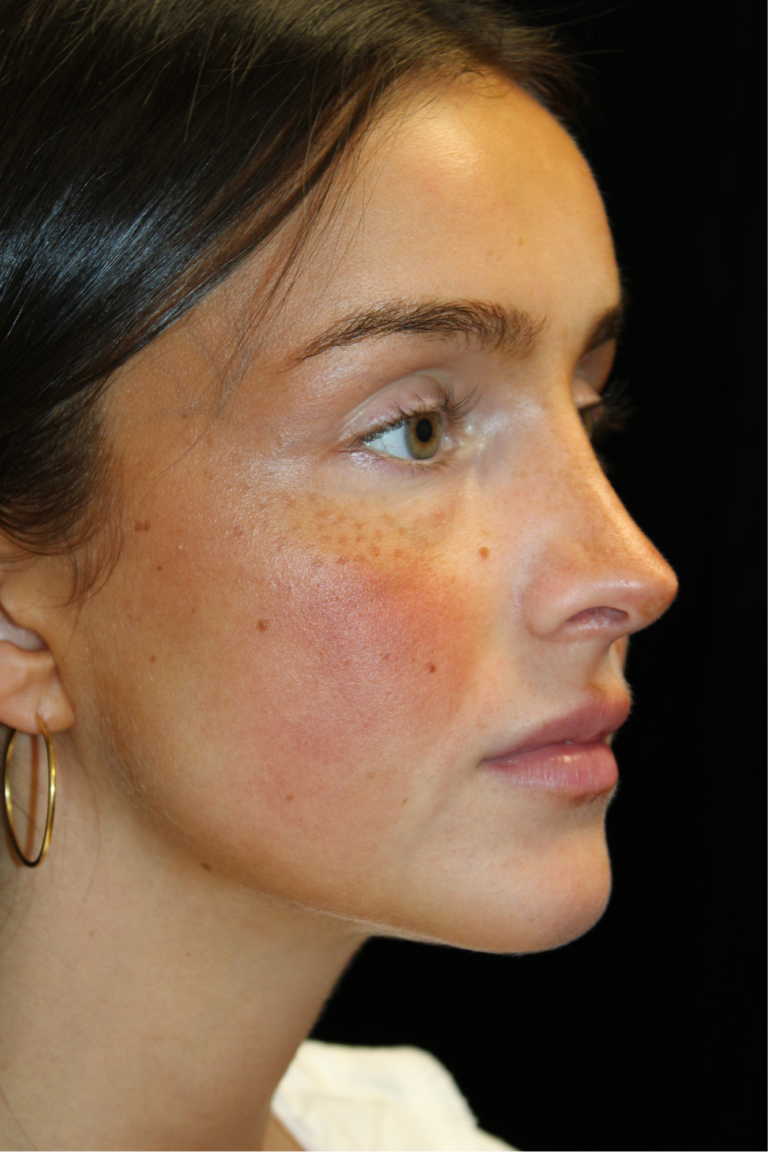 After Image: Closed Preservation Septorhinoplasty - right-front-oblique