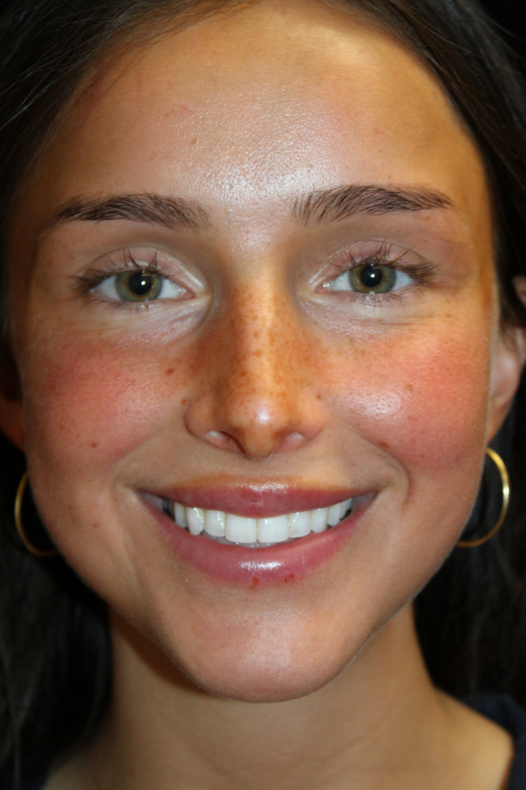 Before Image: Closed Preservation Septorhinoplasty - front