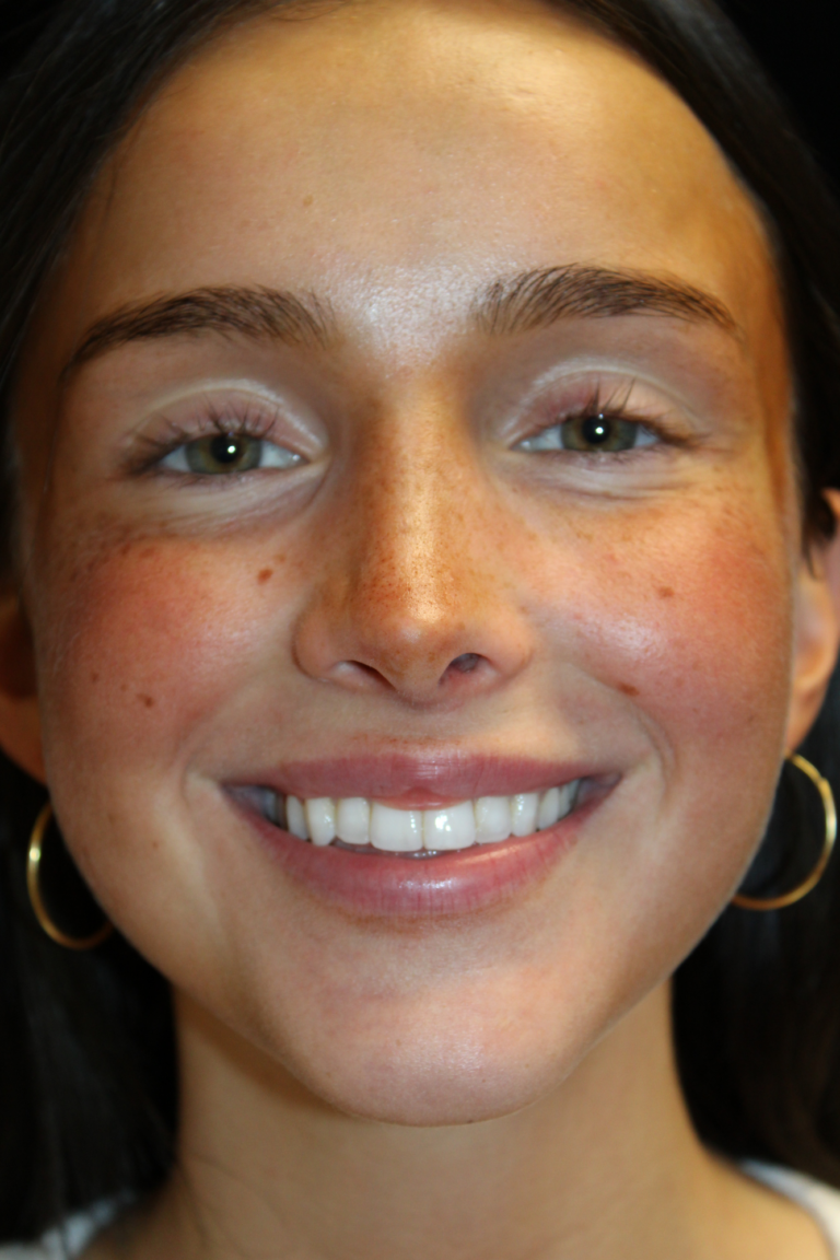 After Image: Closed Preservation Septorhinoplasty - front