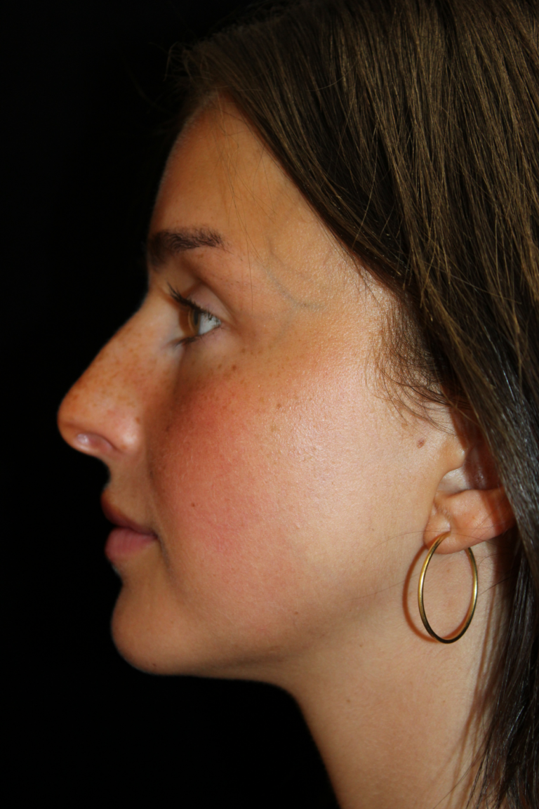 Before Image: Closed Preservation Septorhinoplasty - left-side