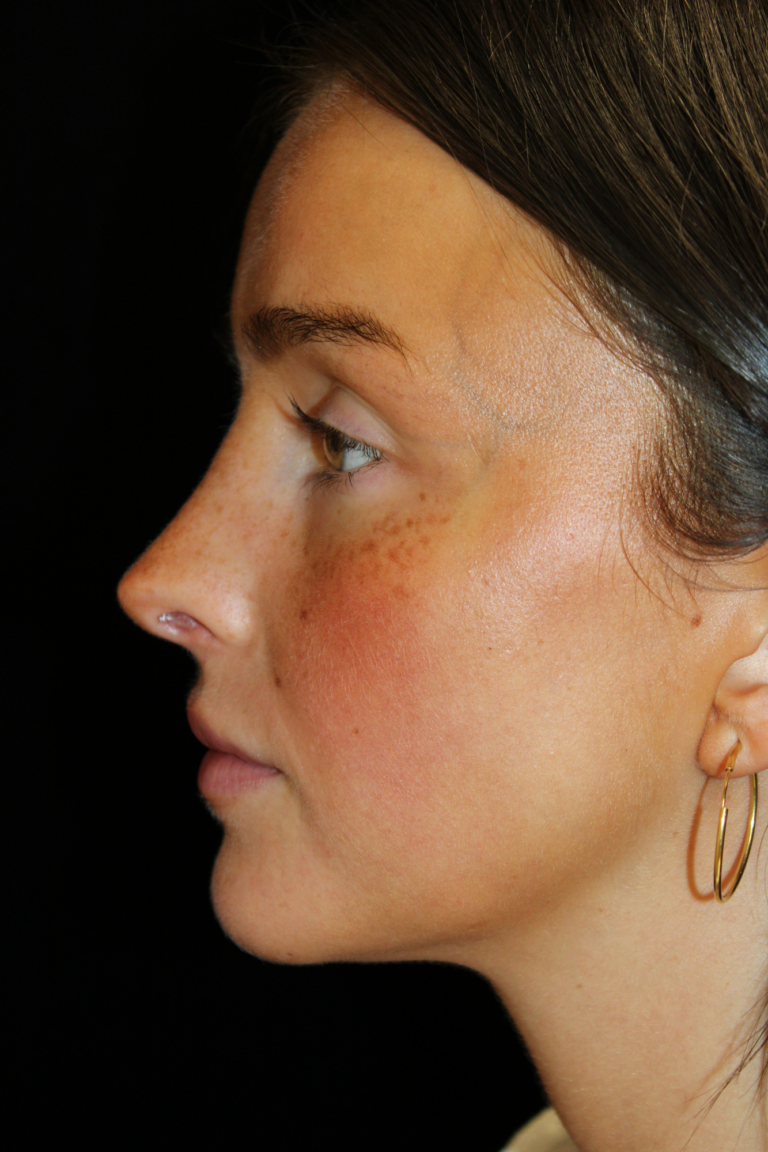 After Image: Closed Preservation Septorhinoplasty - left-side