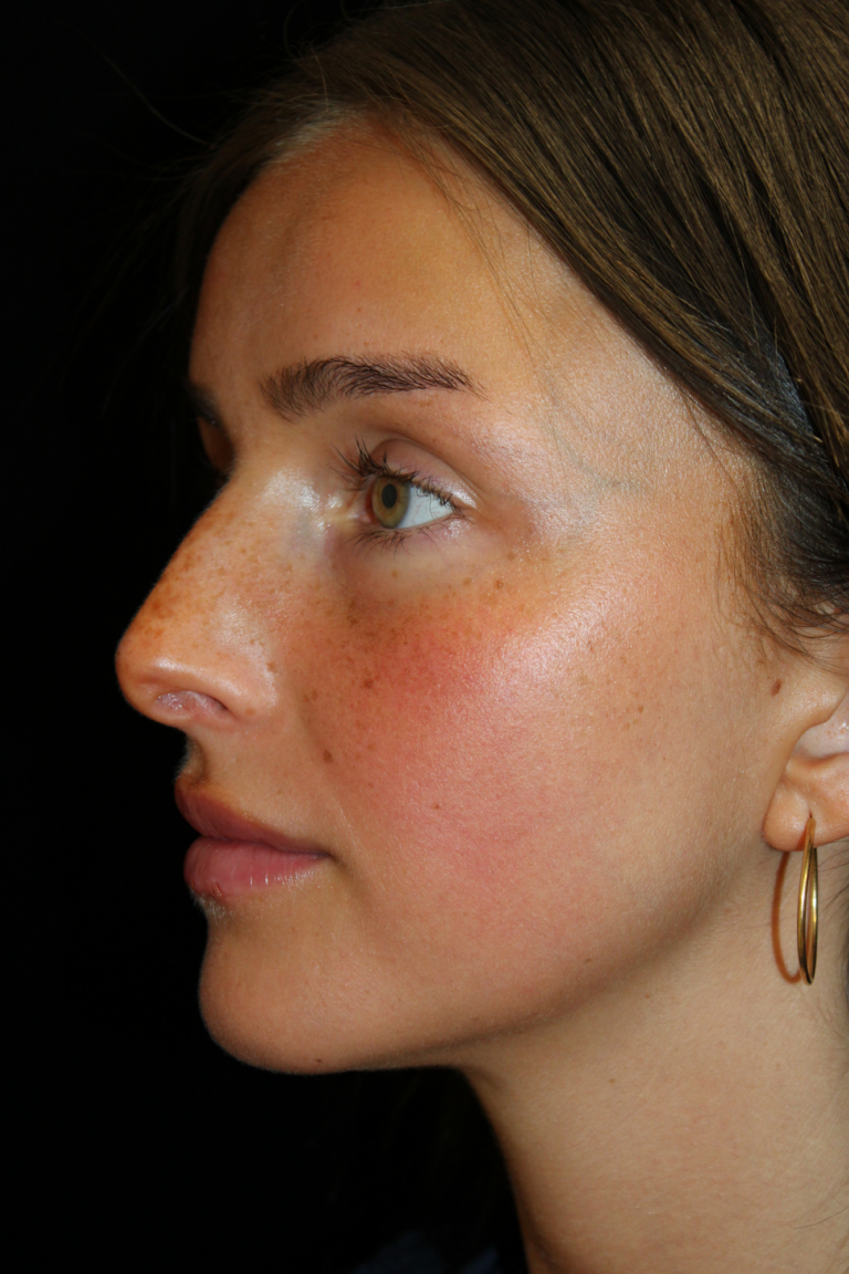 Before Image: Closed Preservation Septorhinoplasty - left-front-oblique