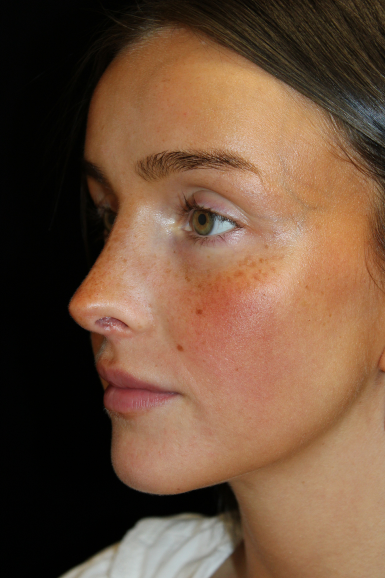 After Image: Closed Preservation Septorhinoplasty - left-front-oblique