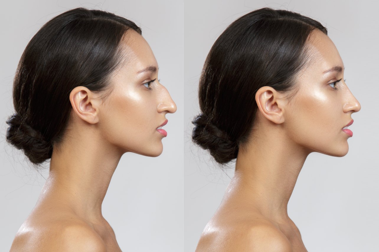 PreservationRhinoplasty1844346289
