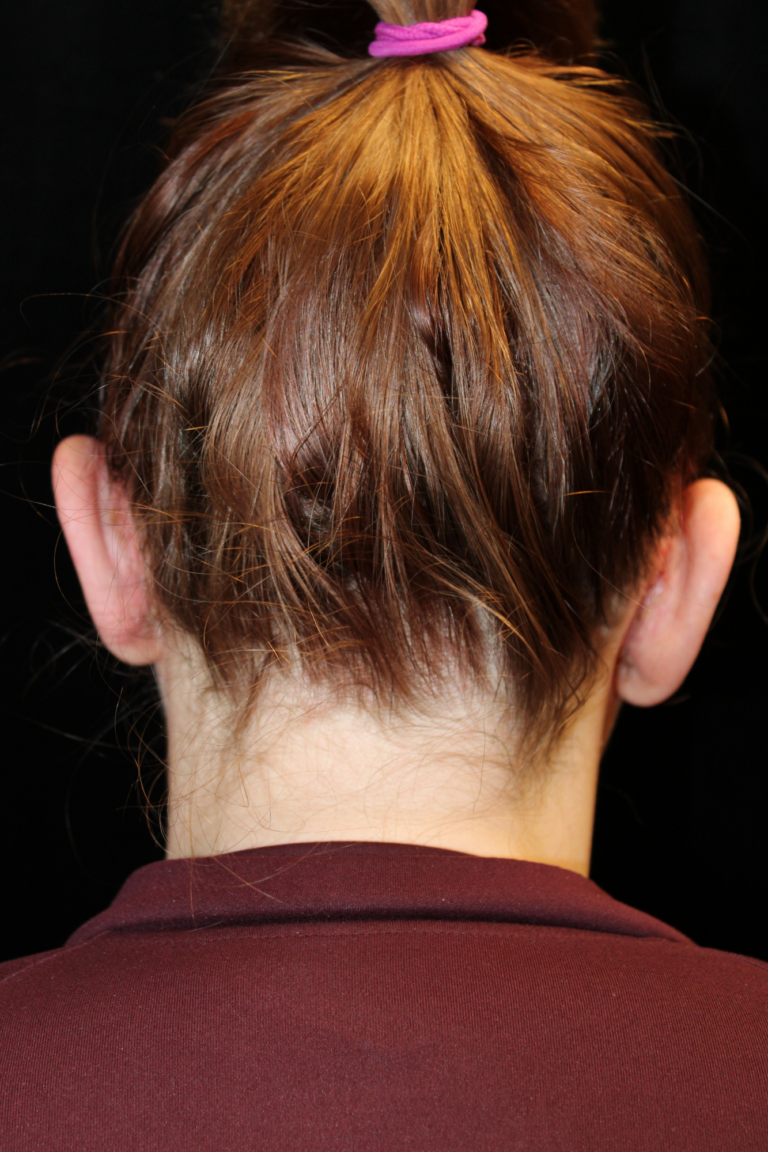After Image: Otoplasty - back
