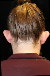 Before Image: Otoplasty