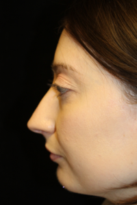 Before Image: Preservation Rhinoplasty