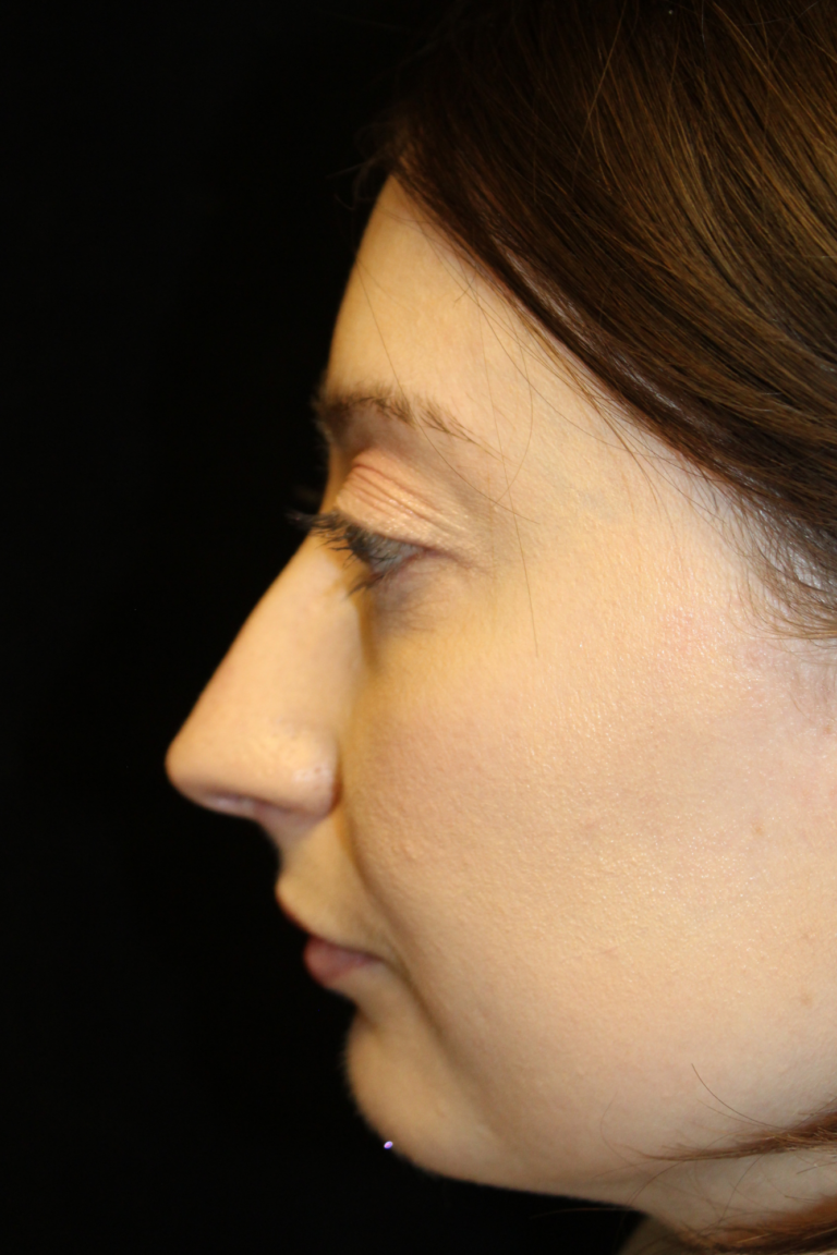 Before Image: Preservation Rhinoplasty - left-side