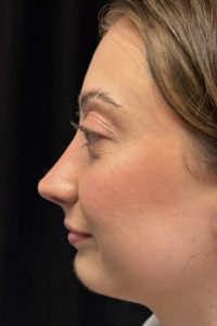 After Image: Preservation Rhinoplasty