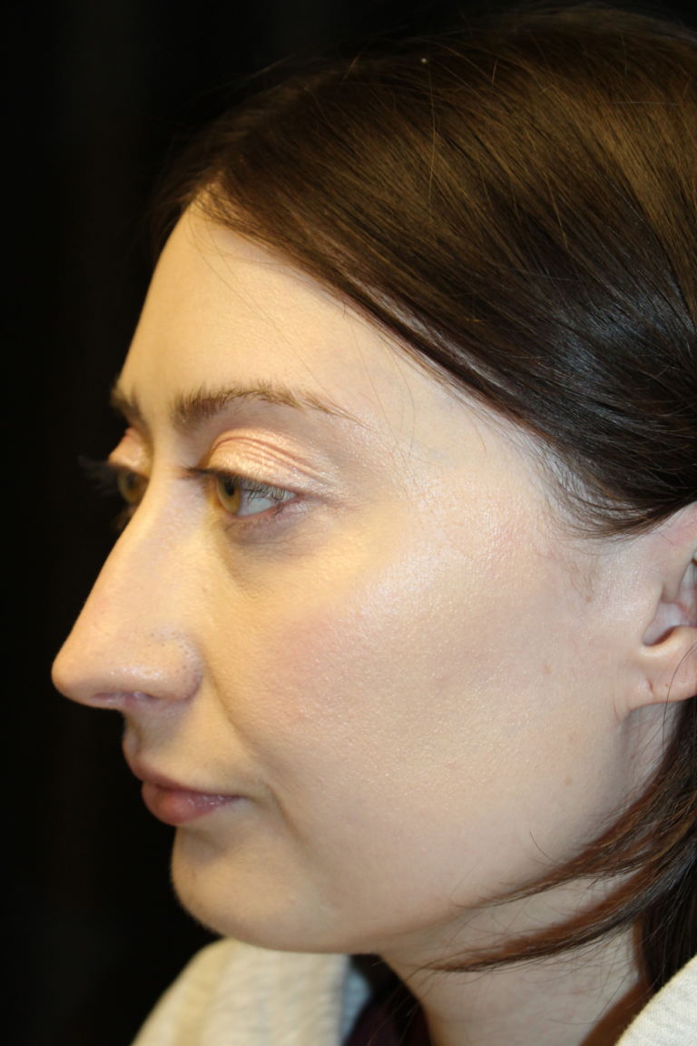 Before Image: Preservation Rhinoplasty - left-front-oblique