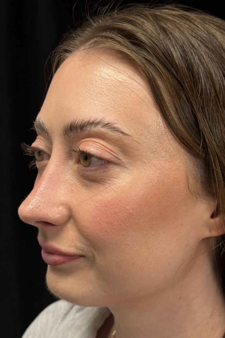 After Image: Preservation Rhinoplasty - left-front-oblique