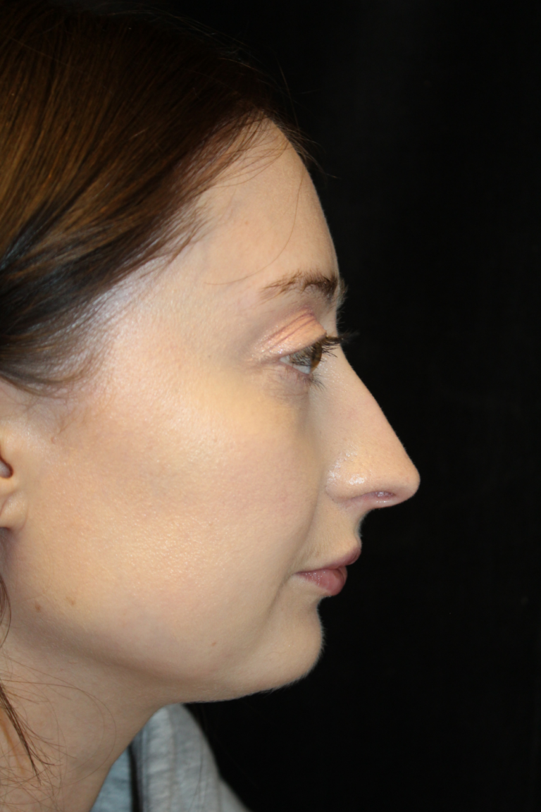Before Image: Preservation Rhinoplasty - right-side