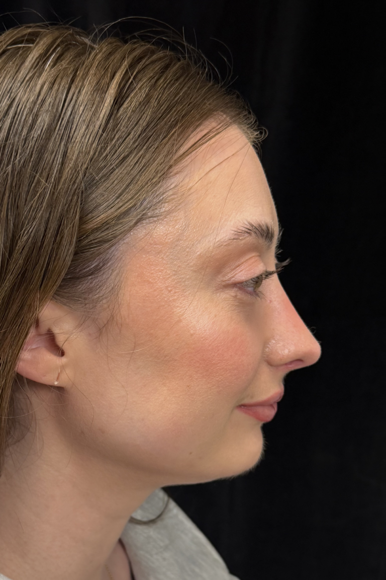After Image: Preservation Rhinoplasty - right-side