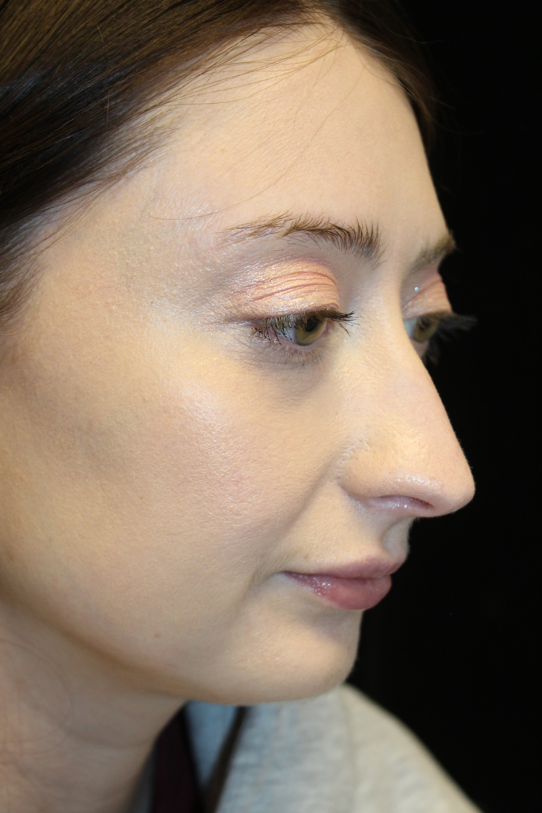 Before Image: Preservation Rhinoplasty - right-front-oblique