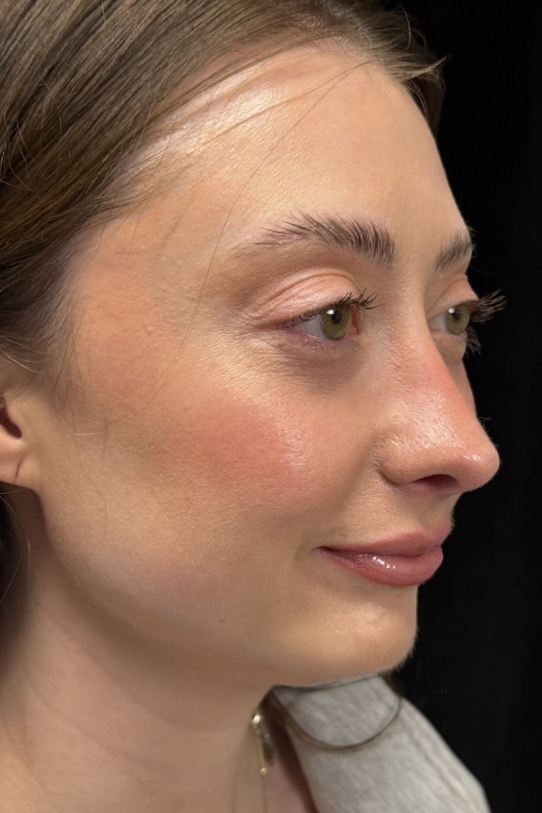After Image: Preservation Rhinoplasty - right-front-oblique