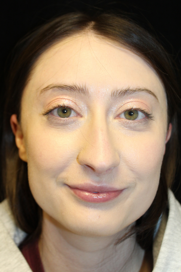 Before Image: Preservation Rhinoplasty - front