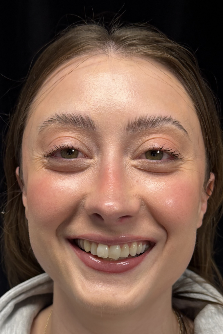 After Image: Preservation Rhinoplasty - front