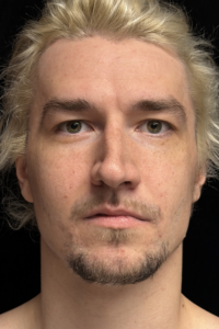 Before Image: Preservation Rhinoplasty