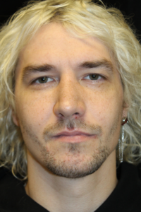 After Image: Preservation Rhinoplasty