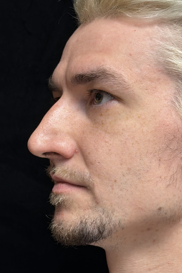 Before Image: Preservation Rhinoplasty - left-front-oblique