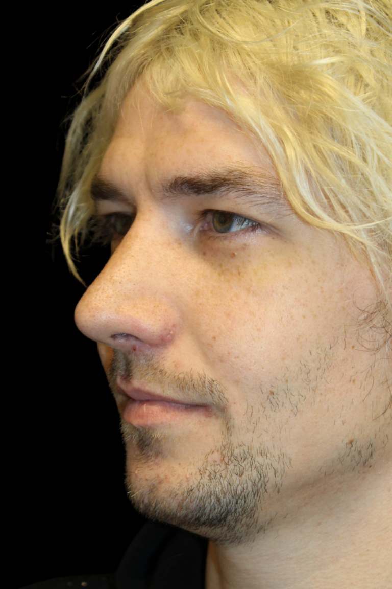 After Image: Preservation Rhinoplasty - left-front-oblique