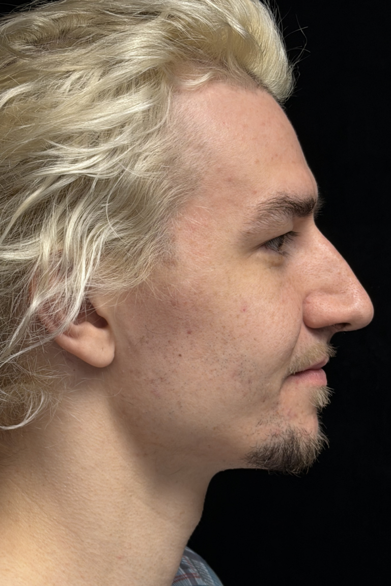 Before Image: Preservation Rhinoplasty - right-side