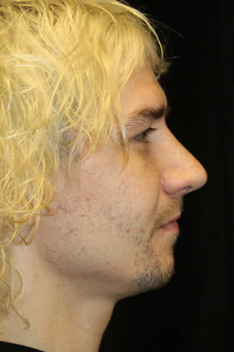 After Image: Preservation Rhinoplasty - right-side