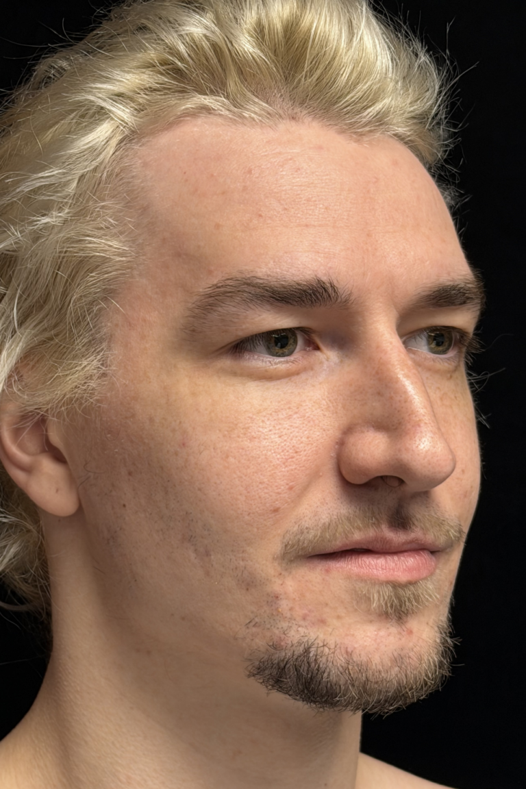 Before Image: Preservation Rhinoplasty - right-front-oblique