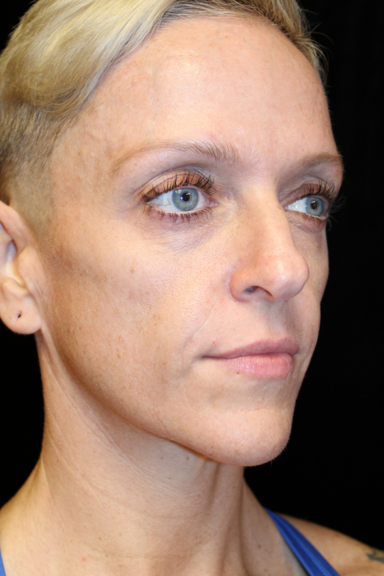 Before Image: Deep Plane Facelift & Deep Plane Neck Contouring - front