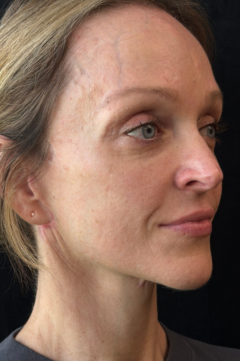 After Image: Deep Plane Facelift & Deep Plane Neck Contouring - front