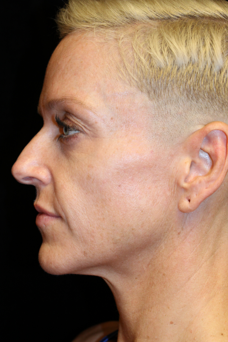 Before Image: Deep Plane Facelift & Deep Plane Neck Contouring - left-side