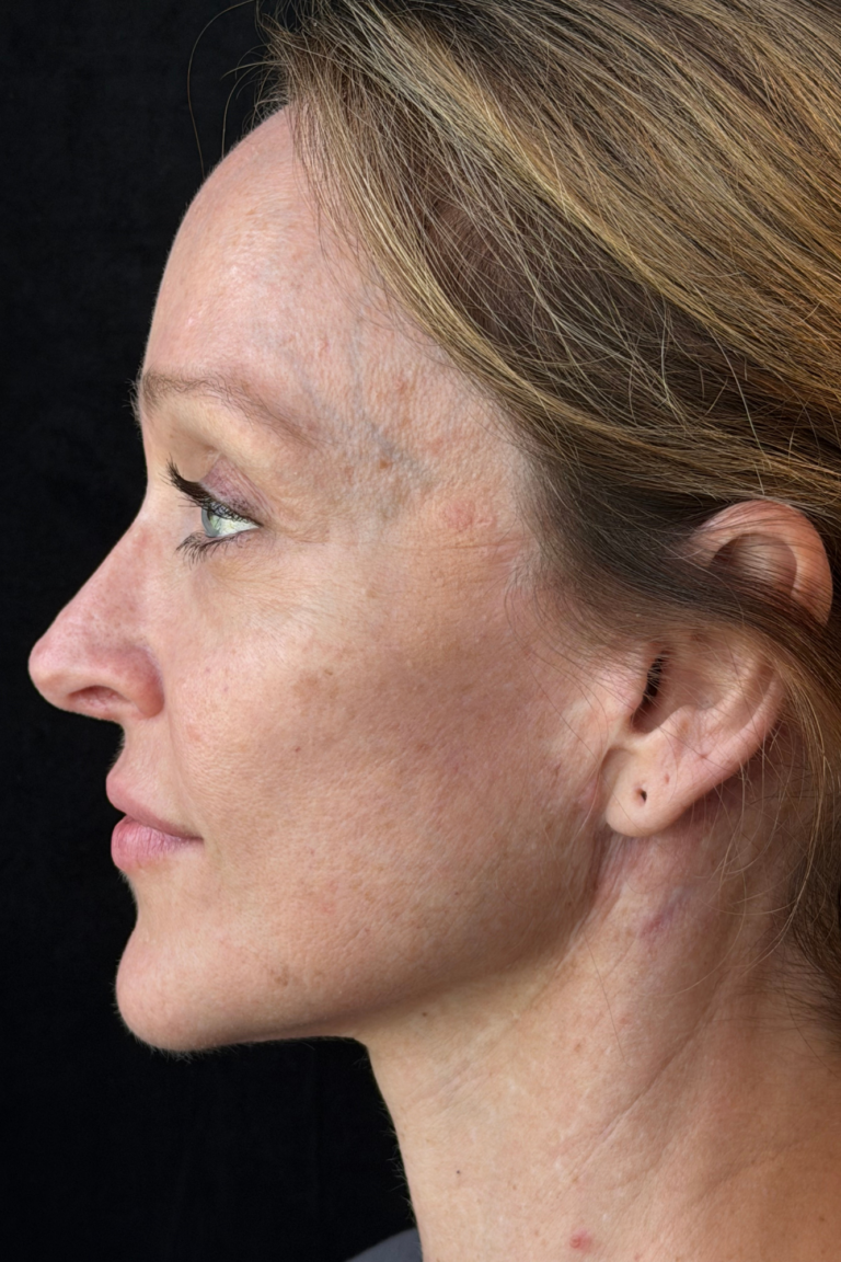 After Image: Deep Plane Facelift & Deep Plane Neck Contouring - left-side