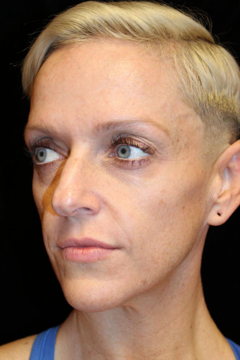 Before Image: Deep Plane Facelift & Deep Plane Neck Contouring - left-front-oblique