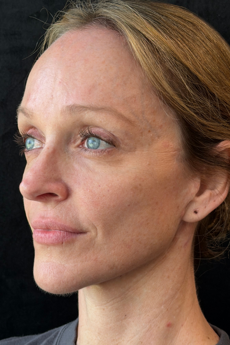 After Image: Deep Plane Facelift & Deep Plane Neck Contouring - left-front-oblique