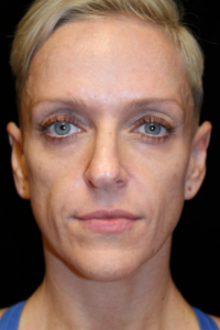Before Image: Deep Plane Facelift & Deep Plane Neck Contouring