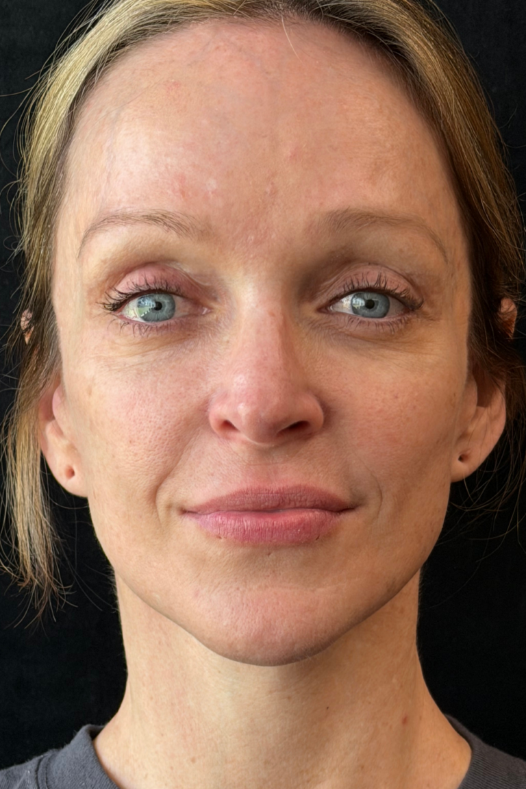 After Image: Deep Plane Facelift & Deep Plane Neck Contouring - front