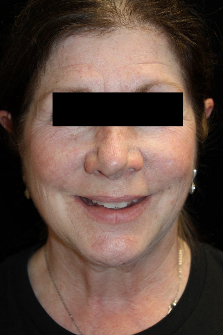 Before Image: Deep Plane Facelift & Neck Lift - front