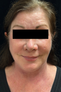 After Image: Deep Plane Facelift & Neck Lift