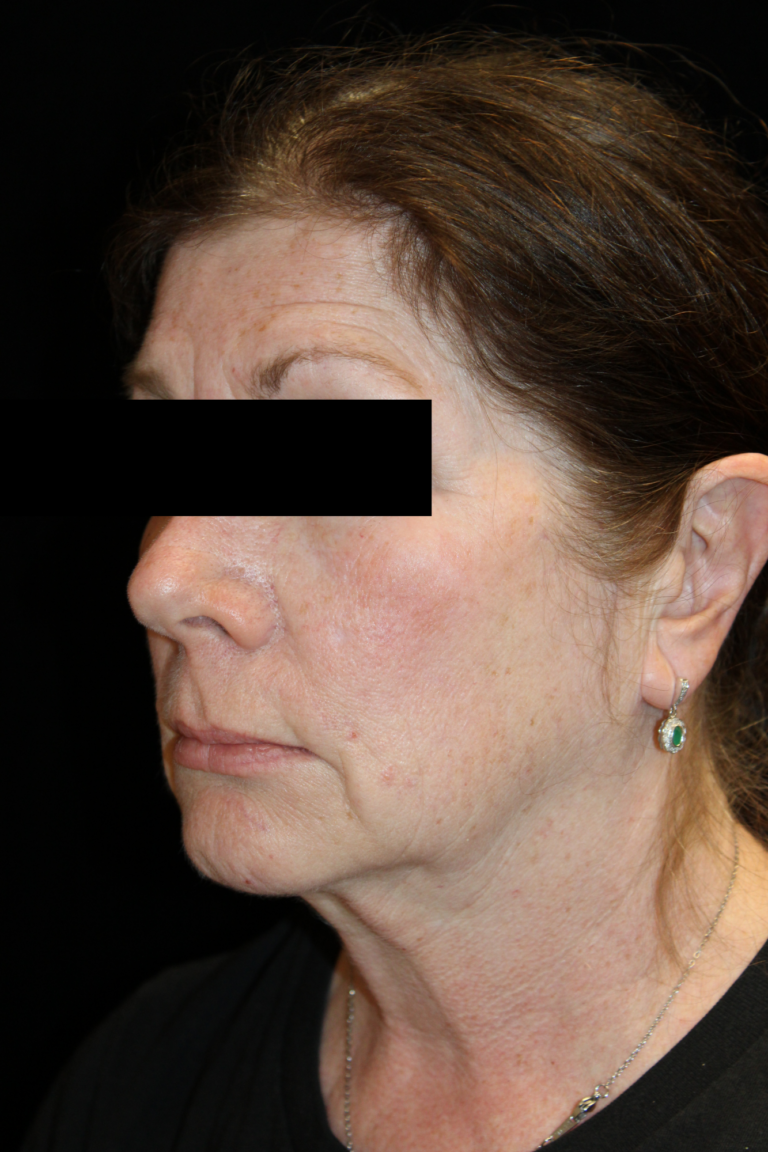 Before Image: Deep Plane Facelift & Neck Lift - 
