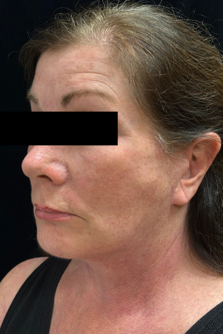 After Image: Deep Plane Facelift & Neck Lift - 