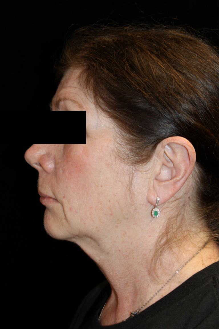 Before Image: Deep Plane Facelift & Neck Lift - left-side