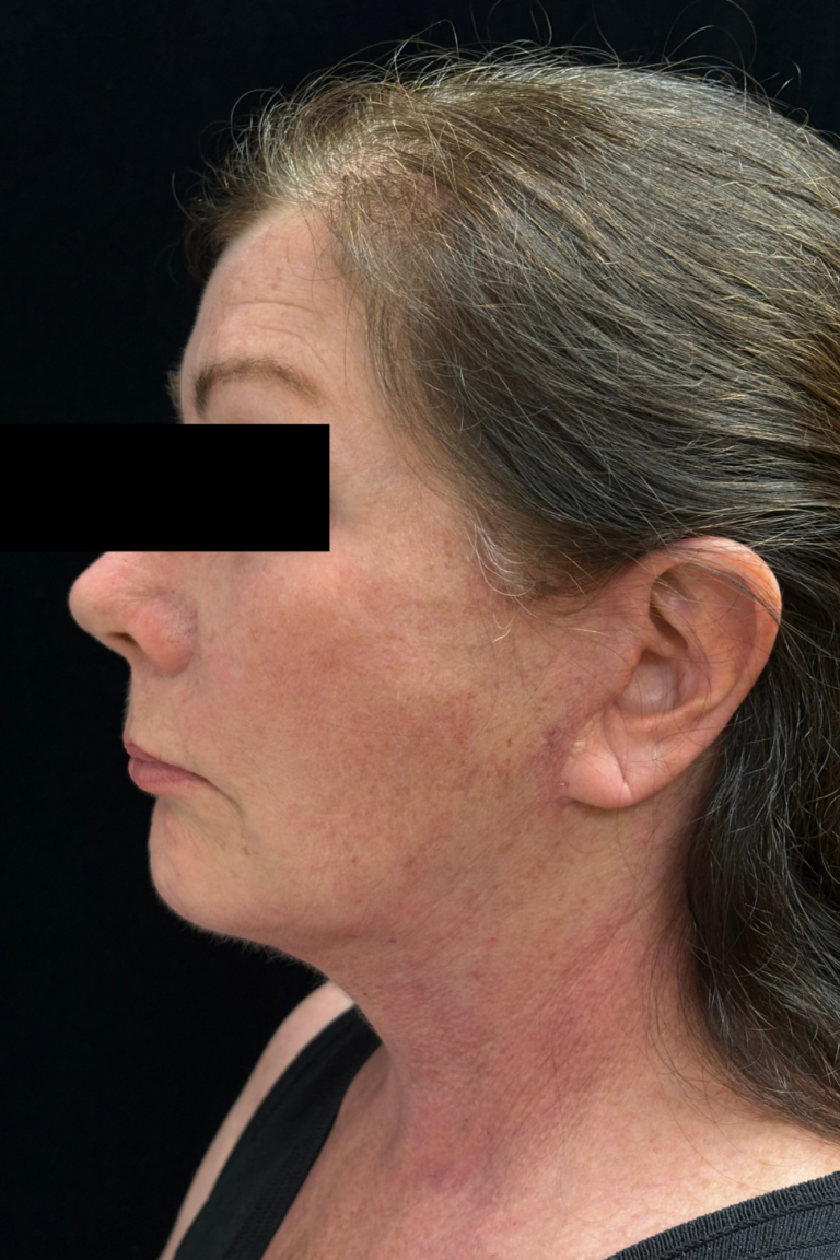 After Image: Deep Plane Facelift & Neck Lift - left-side