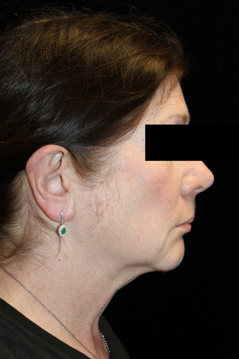 Before Image: Deep Plane Facelift & Neck Lift - right-side