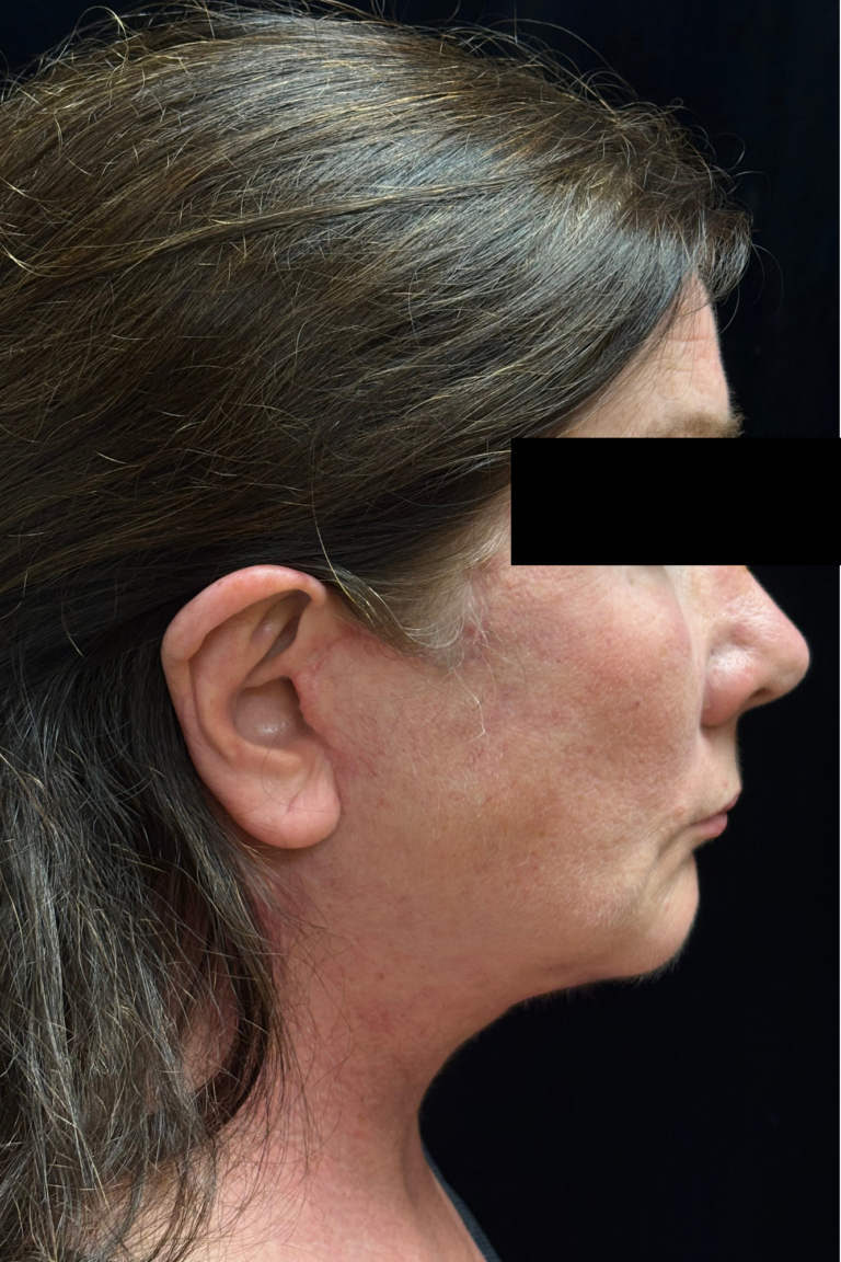 After Image: Deep Plane Facelift & Neck Lift - right-side
