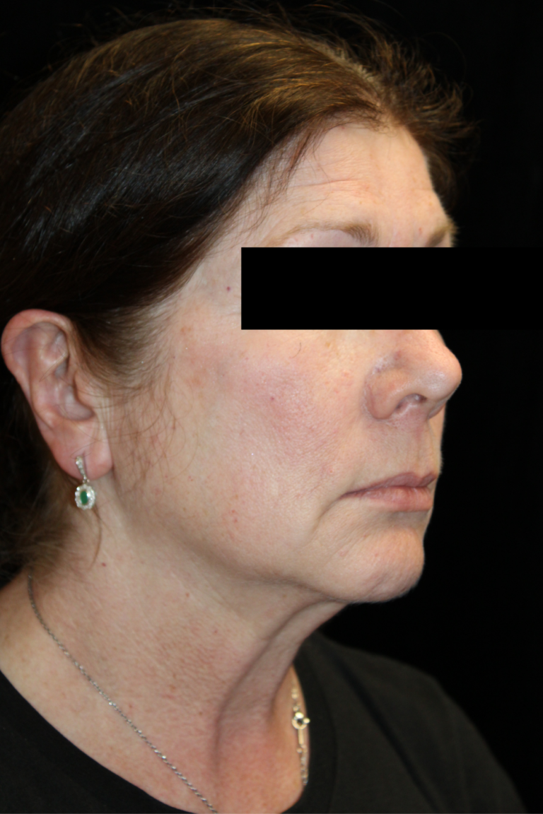 Before Image: Deep Plane Facelift & Neck Lift - 