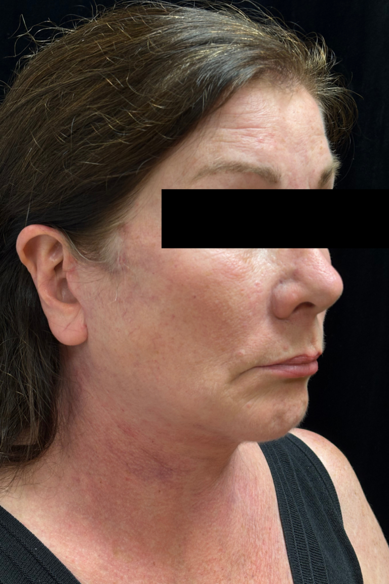 After Image: Deep Plane Facelift & Neck Lift - 