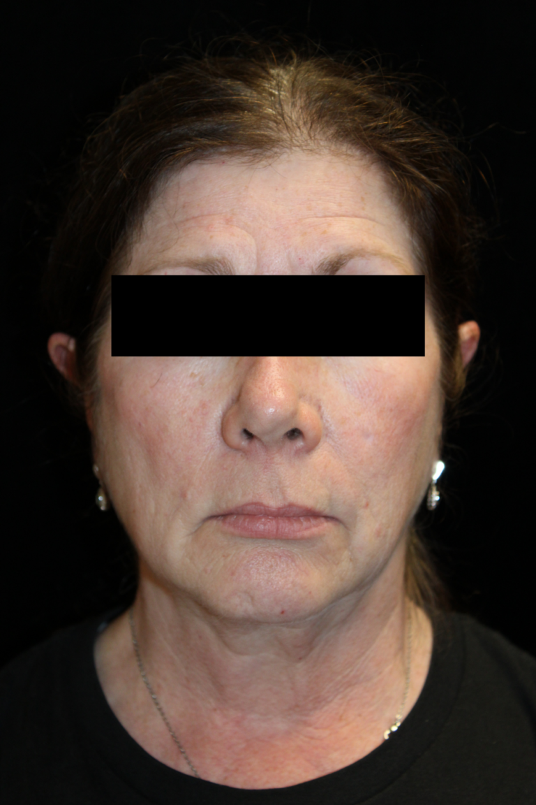 Before Image: Deep Plane Facelift & Neck Lift - front