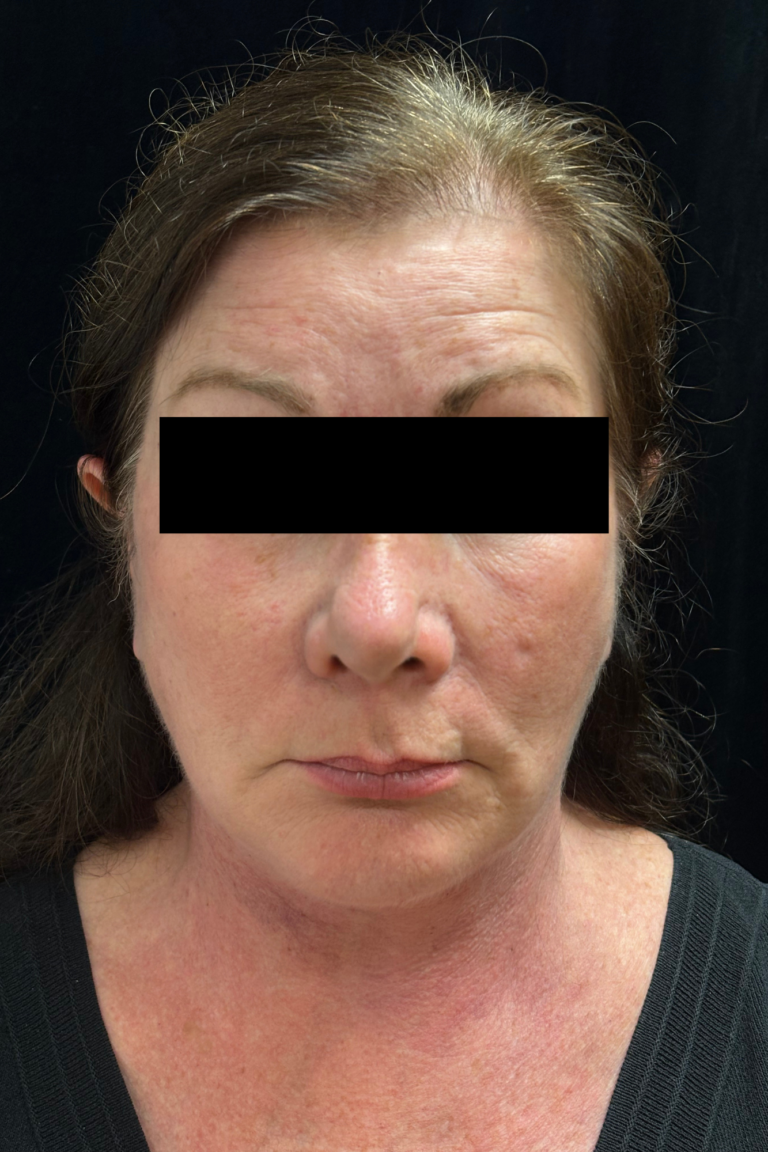 After Image: Deep Plane Facelift & Neck Lift - front